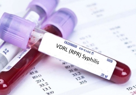 Phát hiện bệnh giang mai bằng xét nghiệm VDRL