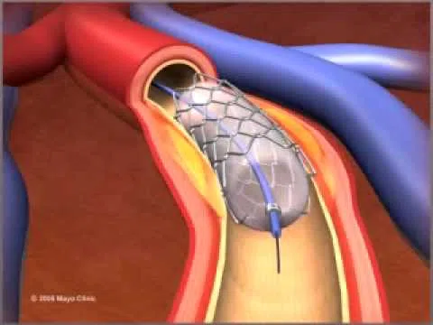 Thủ thuật bung bóng stent vào động mạch vành