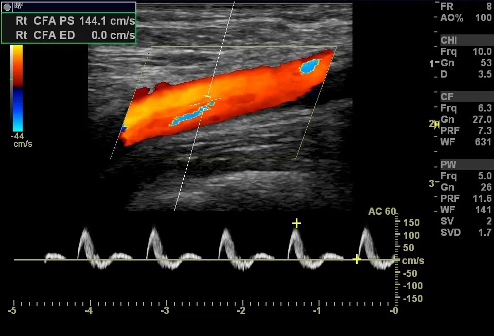 Доплер нижних. Допплеровское исследование сосудов нижних конечностей. УЗДГ – ультразвуковая допплерография сосудов. Ультразвуковая допплерография артерий нижних конечностей. Доплер УЗИ сосудов нижней конечности.