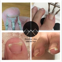 Dụng cụ chữa móng quặp, móng chân chọc thịt đau đớ...